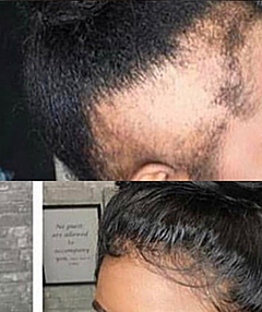 What Edges? Balding Edges and what could be causing it.